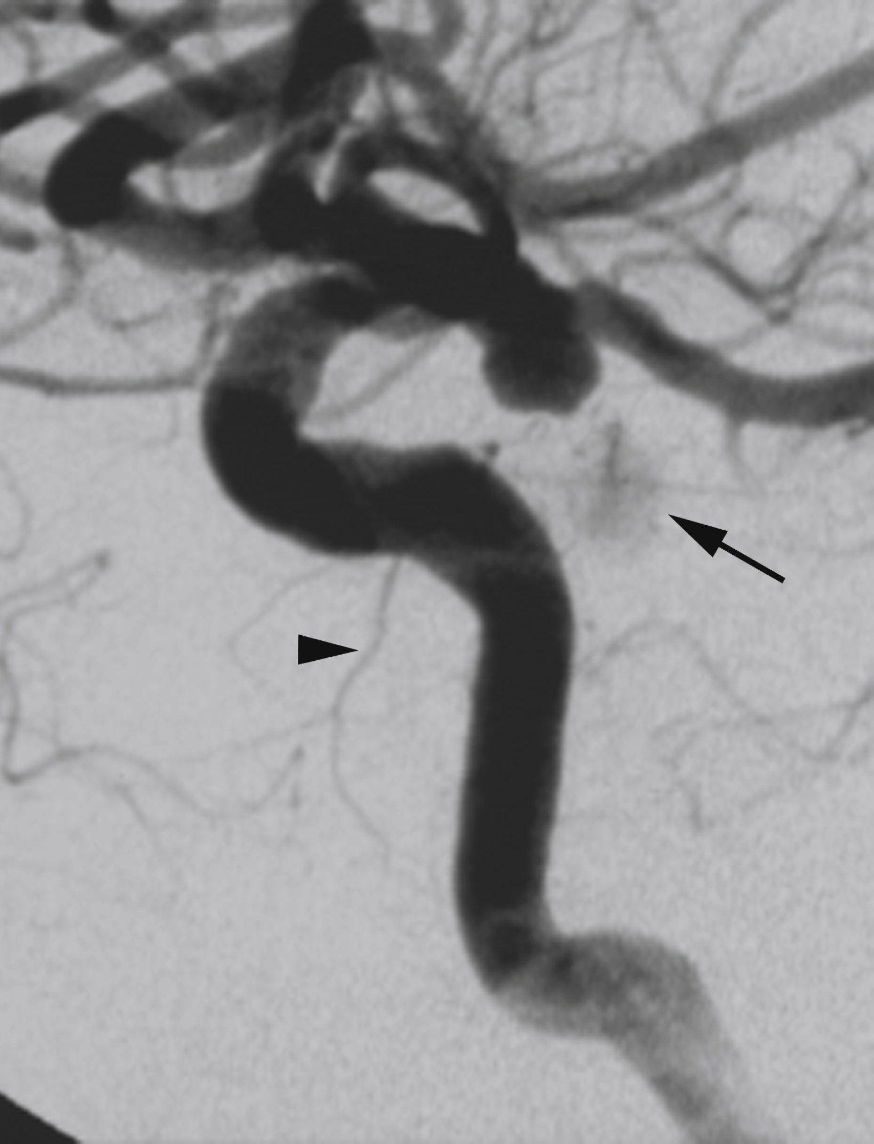 Fig. 56.8, Digital subtraction angiogram, internal carotid artery injection, lateral view. Arrow points at blush of posterior hypophysis. Inferolateral trunk shows typical “inverse Y” appearance ( arrowhead ).