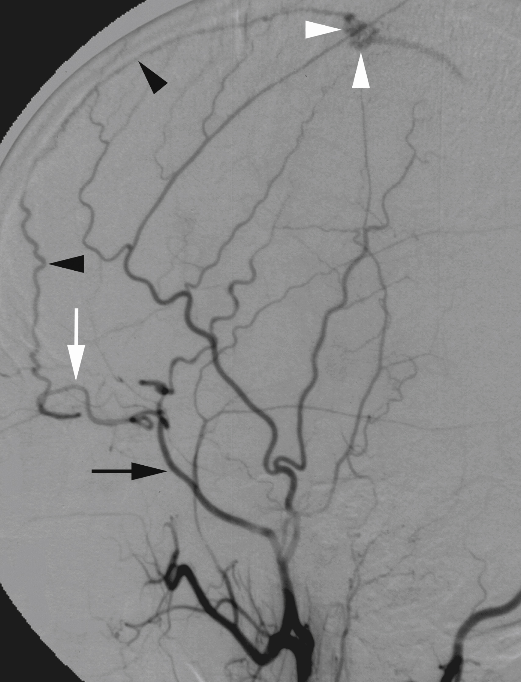 Fig. 56.9, Digital subtraction angiogram, external carotid artery injection, lateral view. Middle meningeal artery ( black arrow ) provides ophthalmic artery (OA) ( white arrow ) through its orbital branch. A dural arteriovenous fistula of superior sagittal sinus ( white arrowheads ) is fed by anterior meningeal artery ( black arrowheads ), a branch of OA. If this anatomic configuration is not recognized, embolization may result in major ocular complications.