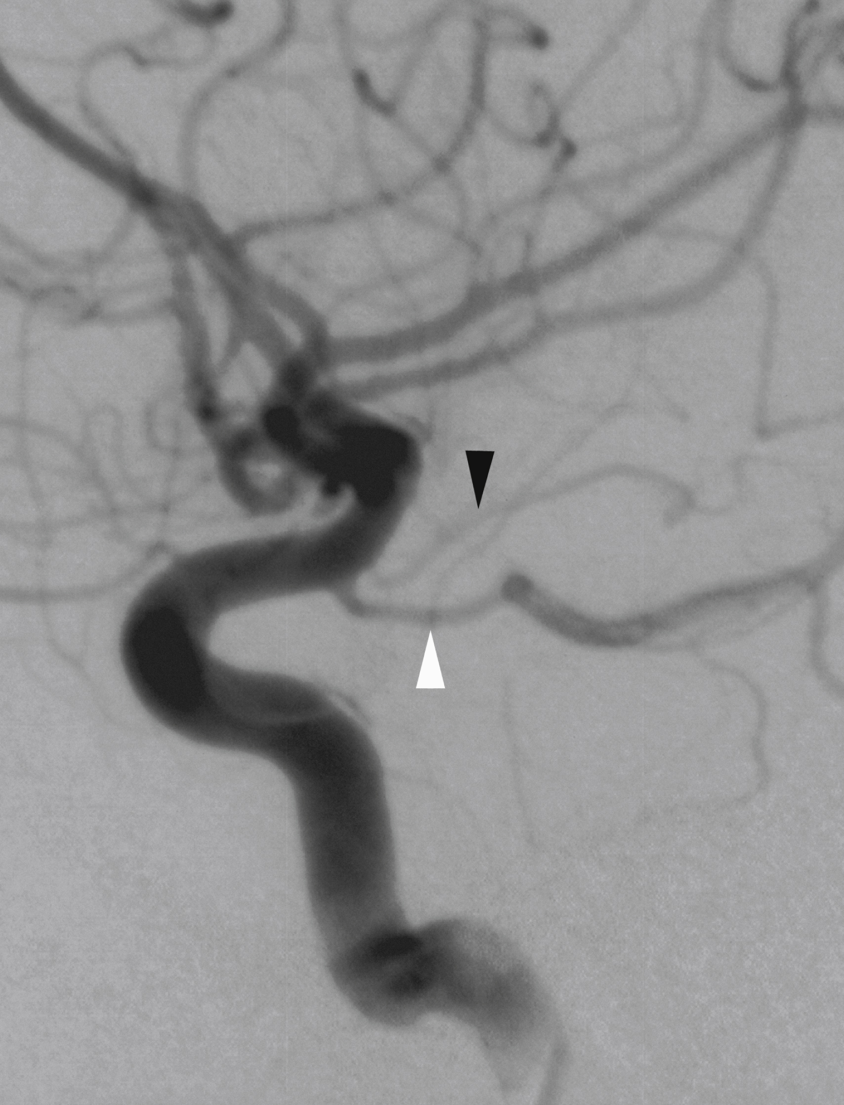 Fig. 56.10, Digital subtraction angiogram, internal carotid artery injection, lateral view showing origin of posterior communicating artery ( white arrowhead ) and anterior choroidal artery ( black arrowhead ).