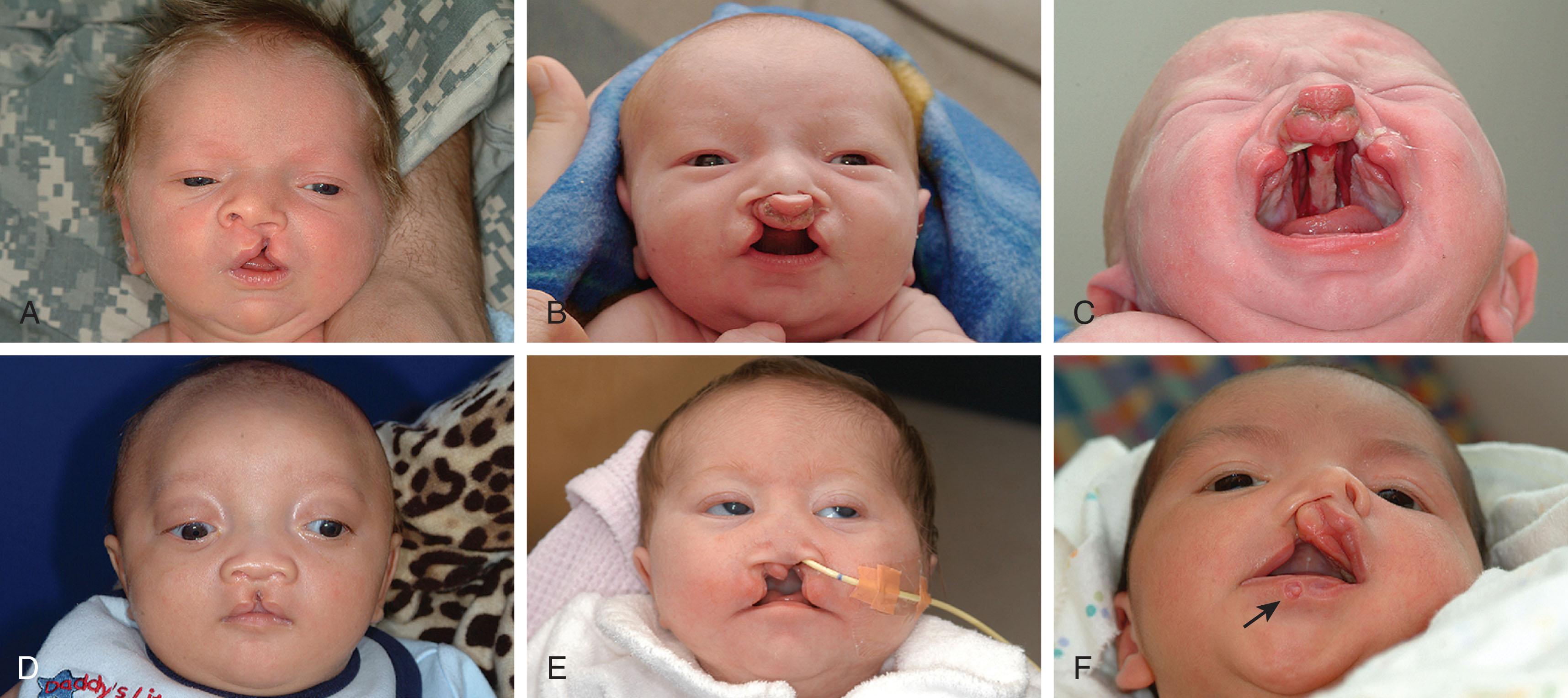 Fig. 88.3, (A) Infant with a unilateral incomplete cleft lip. (B, C) Infant with bilateral complete cleft lip and palate. (D) Infant with midline cleft and hypertelorism. He also has a frontonasal encephalocele. (E) Infant with premaxillary agenesis and holoprosencephaly. (F) Infant with Van der Woude syndrome with unilateral complete cleft lip and a lip pit ( arrow ).