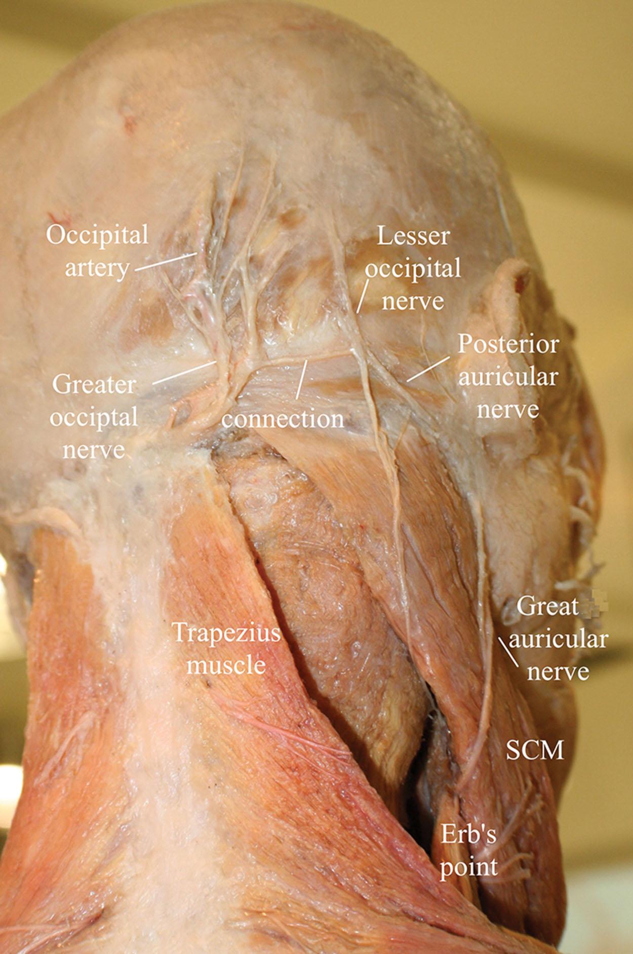 Figure 32.1, Anatomy of the occipital region. Note the connection between the greater and lesser occipital nerves and the posterior auricular nerve. SCM , Sternocleidomastoid.