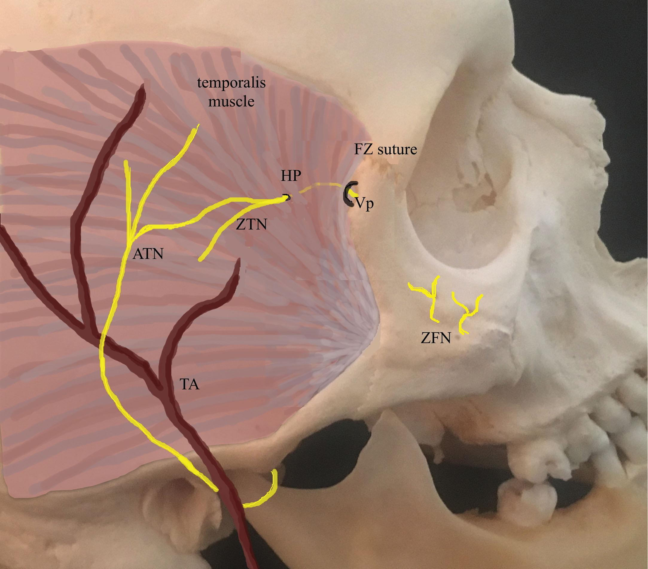 Figure 32.2, Relationship between the zygomaticotemporal branch of the facial nerve, the auriculotemporal nerve, and the temporal artery. The Vp (1.1 ± 0.3 cm below the FZ suture and 2.2 ± 0.3 cm above the zygomatic arch) is a location where the ZTN may be injured. ATN , Auriculotemporal nerve; FZ suture, frontozygomatic suture; TA , temporalis artery; Vp , vulnerable point; ZFN , zygomaticofacial nerve; ZTN , zygomaticotemporal nerve.