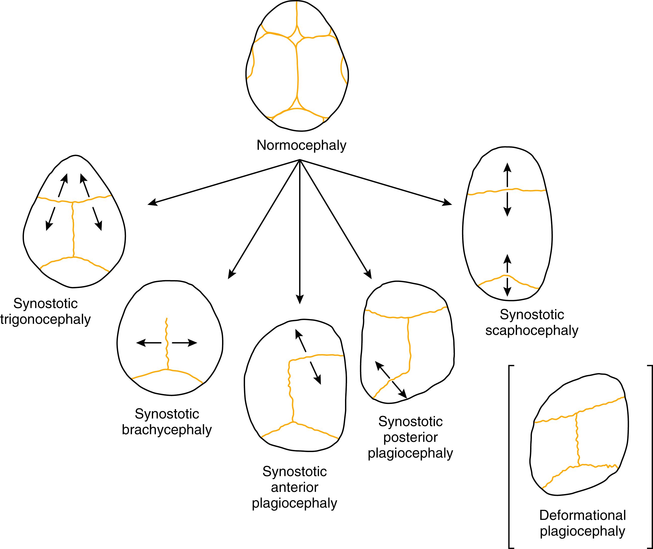 Fig. 6.1, In craniosynostosis, growth is prevented from occurring across the fused suture. Arrows demonstrate compensatory growth that occurs across open sutures with continued intracranial expansion.