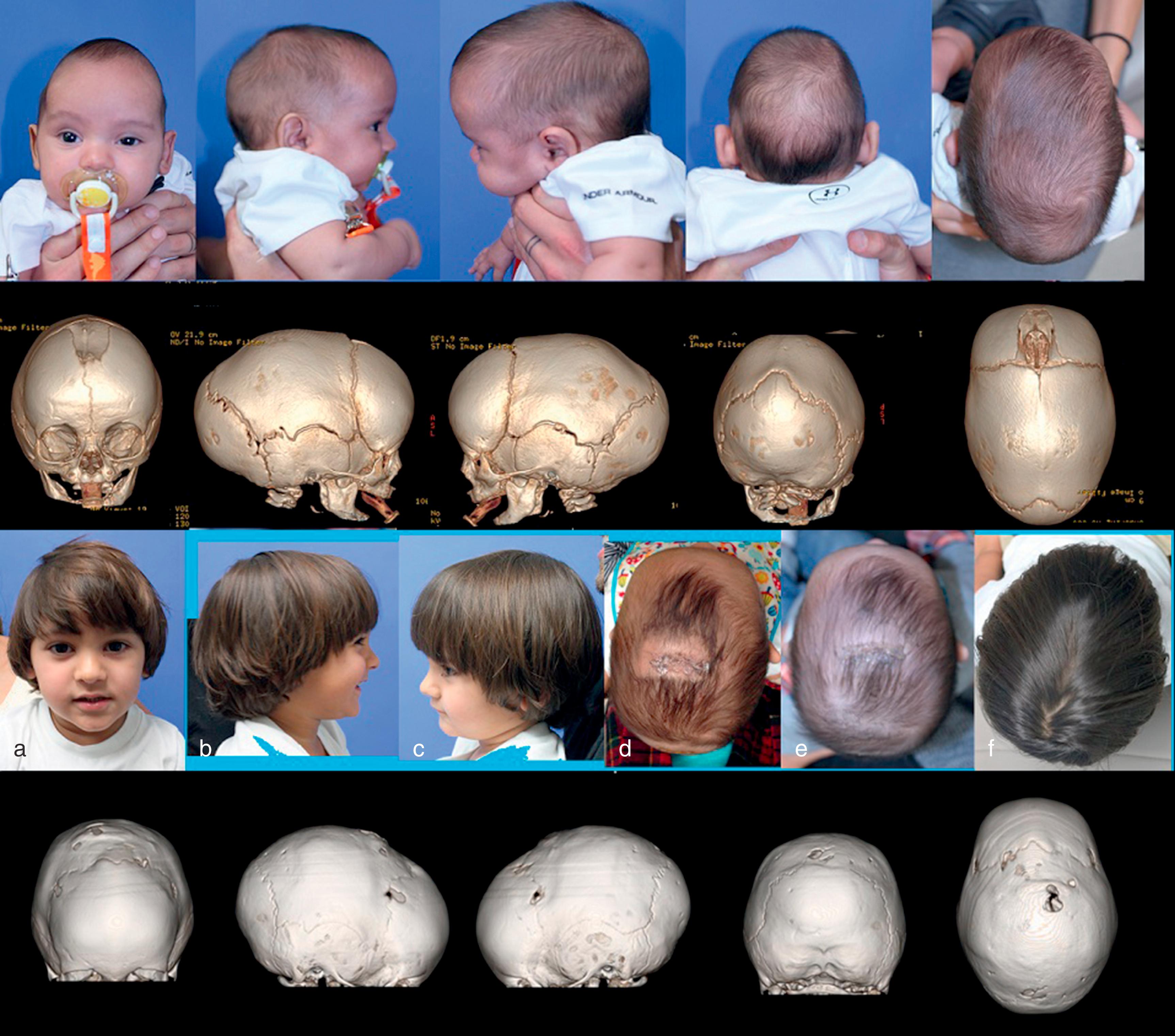 Fig. 6.2, A 3.5-month-old baby with sagittal craniosynostosis, from left to right: frontal, right lateral, left lateral, occipital, and vertex views. Row 1: Preoperative photographs (cephalic index 65.8% preoperatively). Row 2: Preoperative three-dimensional computed tomography (3DCT) images. Row 3: (a), (b), (c), (f) Views from 2 years and 8 months postoperative after endoscopic sagittal strip craniectomy with biparietal wedge craniectomies near coronal and lambdoid sutures; (d) 1 week postoperative vertex view; (e) 5 weeks postoperative vertex view. Row 4: 2 years 10 months postoperatively 3DCT (cephalic index 77.1% postoperative at 2 years 9 months).