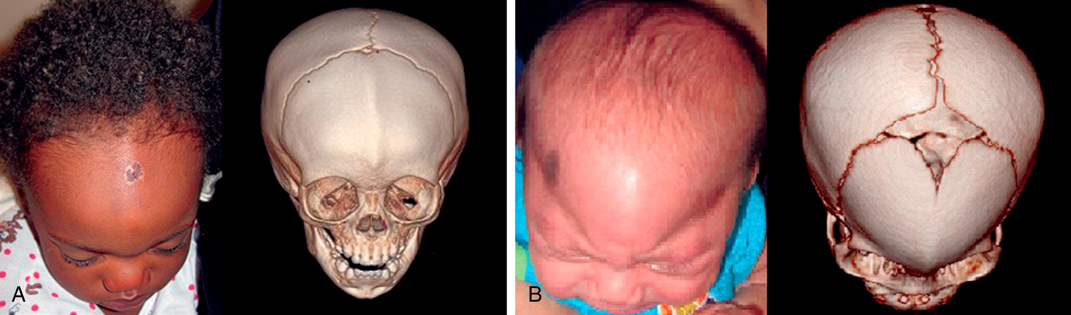 Fig. 6.3, (A) Vertex clinical and three-dimensional computed tomography images of a 15-month-old with mild metopic ridging and minimal trigonocephaly. (B) A 2.5-month-old with severe trigonocephaly.