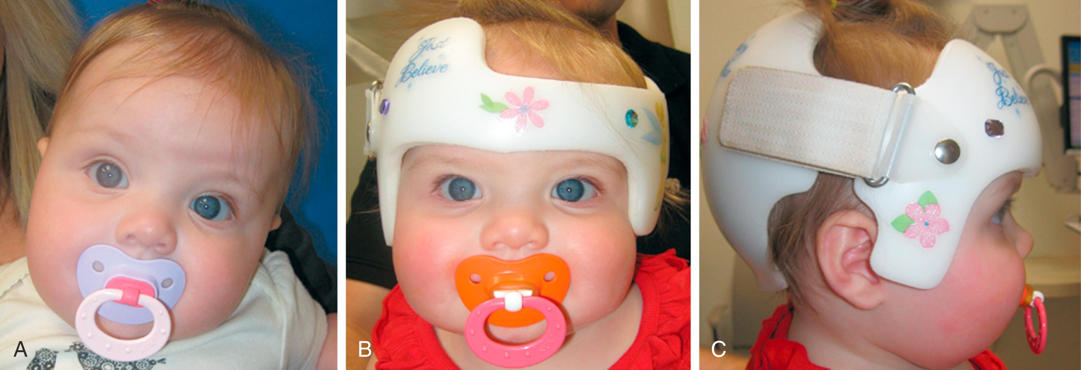 Fig. 6.4, A 6-month-old child with left sternocleidomastoid torticollis and right deformational plagiocephaly before treatment (A) and demonstrating frontal view (B) and lateral view (C) of the orthotic molding helmet.