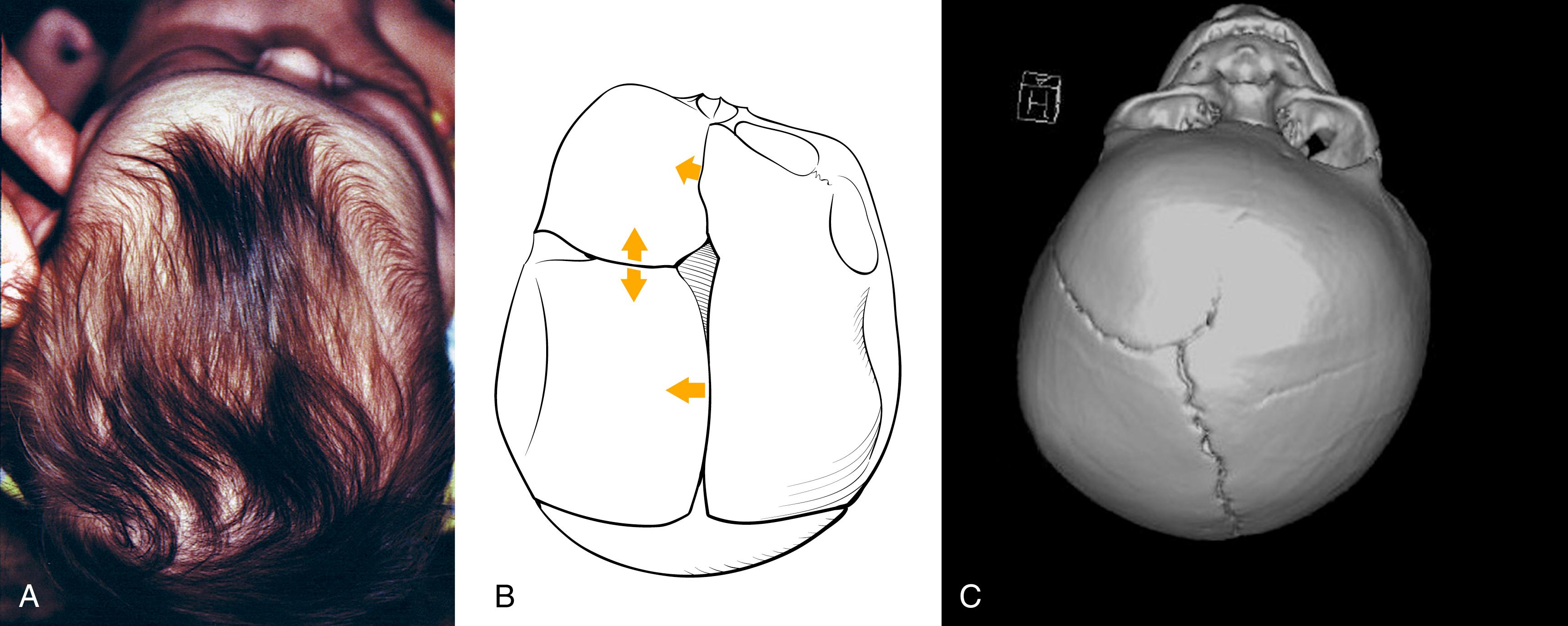 Fig. 6.5, (A) Unilateral coronal synostosis resulting in plagiocephaly. Note that the cranial vault irregularities are not confined to those ipsilateral to the defect. Compensatory growth has resulted in frontal bossing on the contralateral side. (B) A schematic representation of plagiocephaly. (C) Three-dimensional computed tomography in a different child highlighting right unilateral coronal synostosis and frontal flattening.