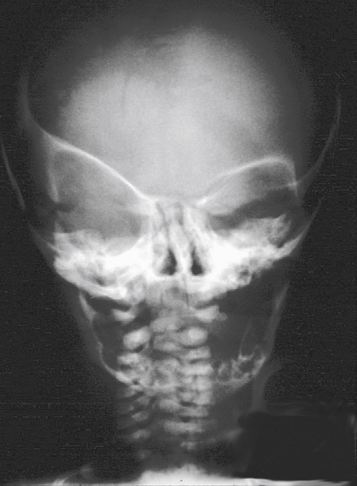 Fig. 6.6, Skull film demonstrating the “harlequin mask” appearance seen in a patient with right unilateral coronal suture synostosis resulting in left orbital downward shift and resultant orbital dystopia.