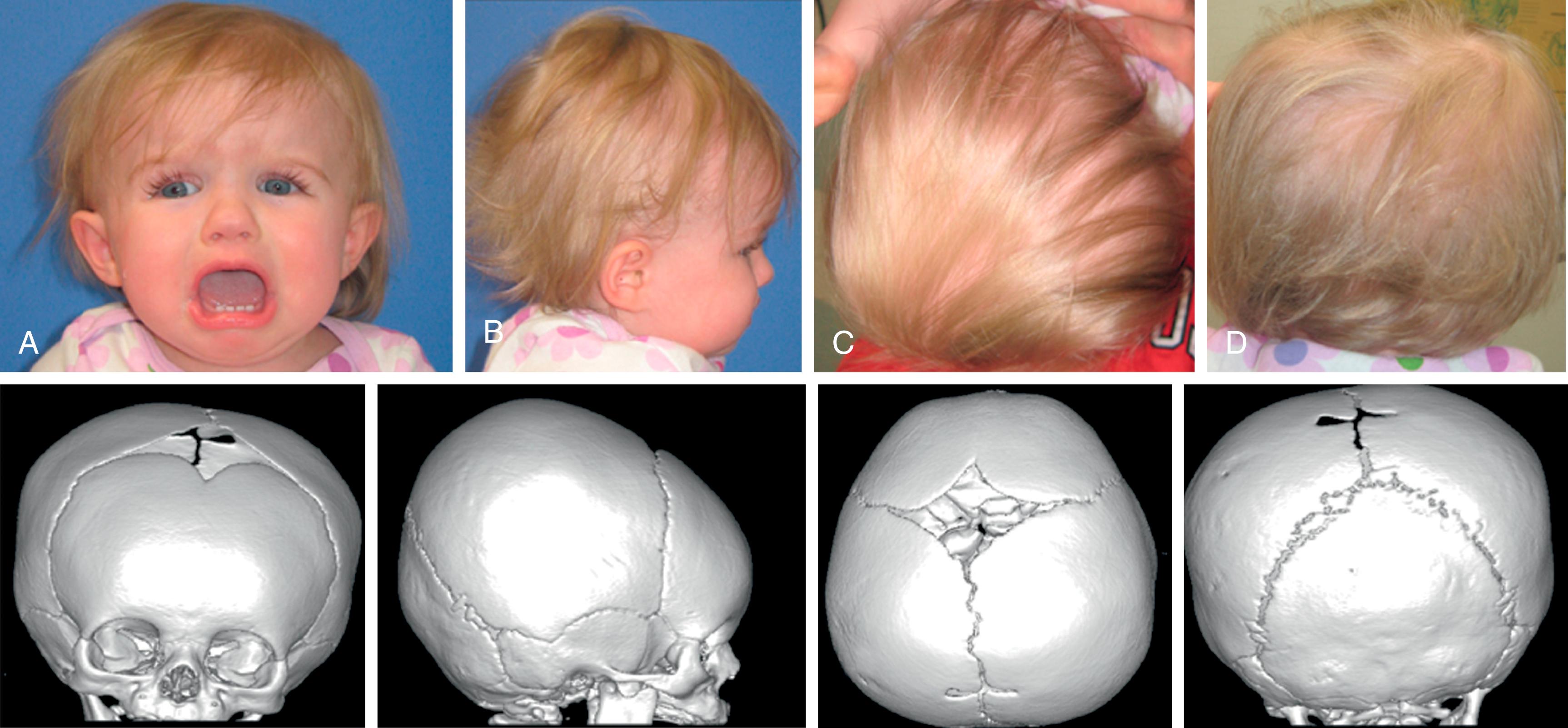 Fig. 6.8, Twelve-month-old girl with positional/nonsynostotic brachycephaly. (A) Frontal clinical and three-dimensional computed tomography (3DCT) images showing a round head and face. (B) Right lateral clinical and 3DCT images showing short head in anteroposterior length (brachycephalic) and mild tower head (turricephaly) in which the posterior skull is higher than the anterior skull. (C) Vertex clinical and 3DCT images show brachycephaly without synostosis. (D) Occipital clinical and 3DCT images show flattened occiput bilaterally without synostosis.
