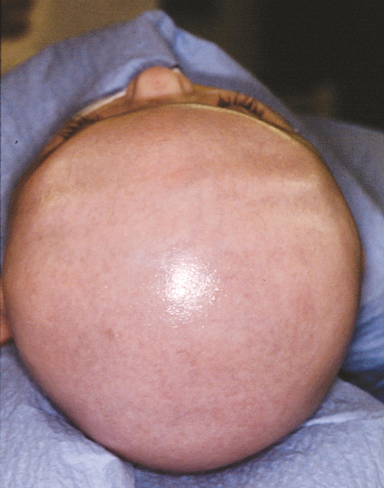 Fig. 6.9, Bilateral coronal suture synostosis resulting in brachycephaly.