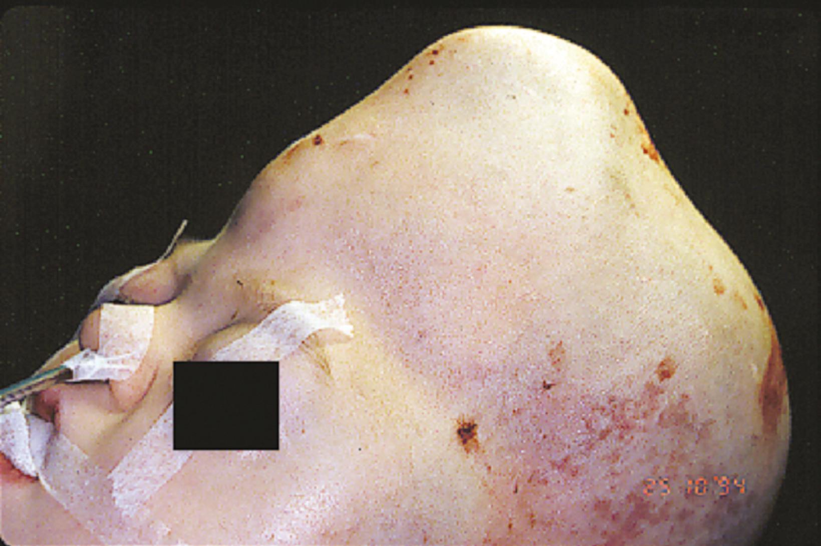 Fig. 6.10, Coronal and sagittal suture synostosis in this child with Apert syndrome resulted in acrocephaly.