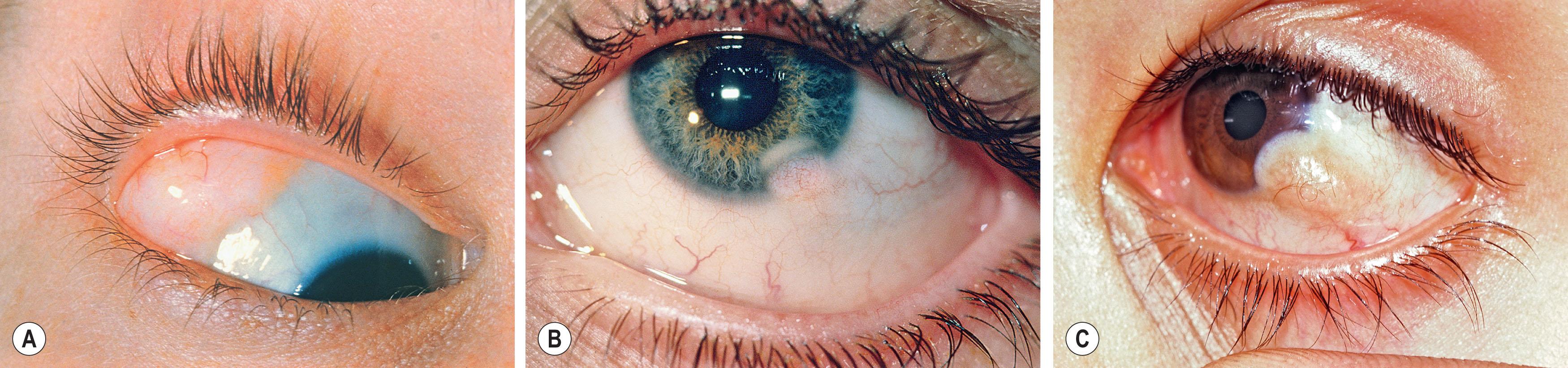 Fig. 26.8, (A) Yellowish subconjunctival dermolipoma in the superotemporal fornix. (B) Epibulbar dermoid of the inferotemporal limbus with leading edge lipid infiltrate in the cornea. (C) This epibulbar dermoid had irritating hairs growing from it.