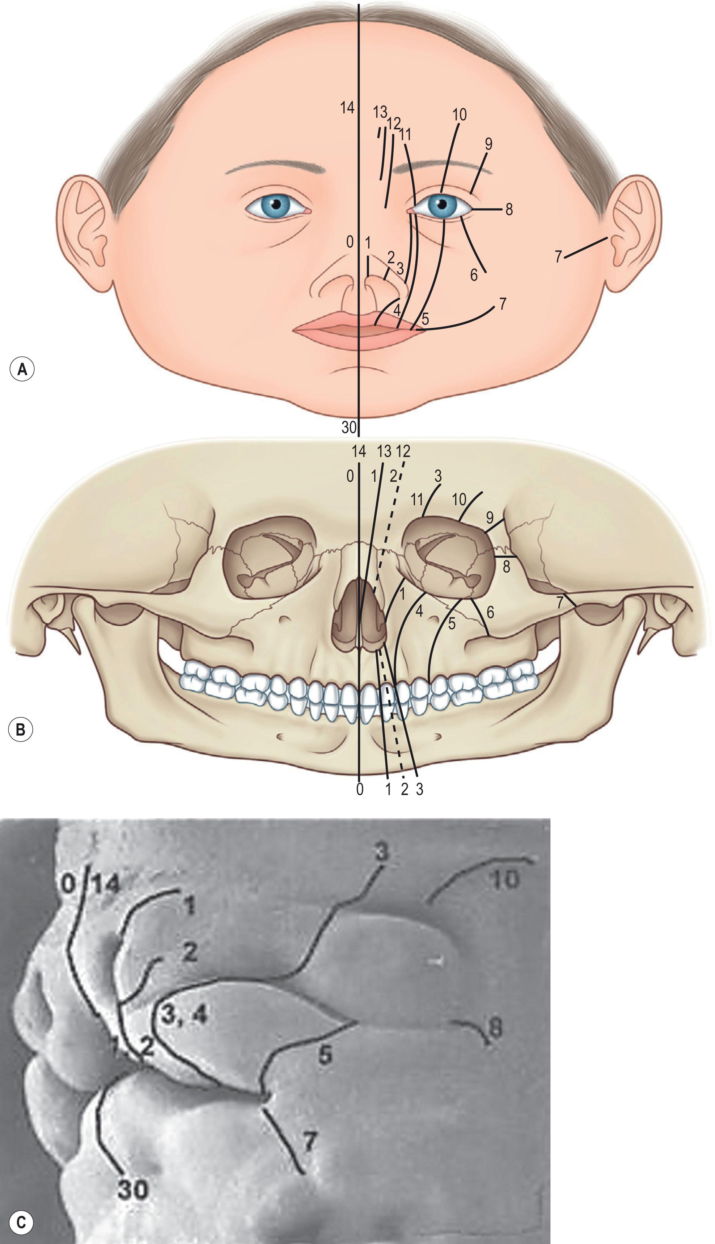 Figure 24.1, Tessier classification of craniofacial clefts. Illustration of Tessier clefts: (A) Soft-tissue landmarks are outlined on the left side of the face (right half of the drawing). (B) Skeletal locations of numeric clefts are depicted on the left side of the face (right half of the drawing). Facial clefts are numbers 0 through 7 and cranial clefts are numbers 8 through 14. Mandibular midline facial cleft is number 30. (C) Embryology correlation to Tessier facial clefts: Tessier-numbered craniofacial clefts are shown correlating with growth center junctions in this 45-day-old fetus.