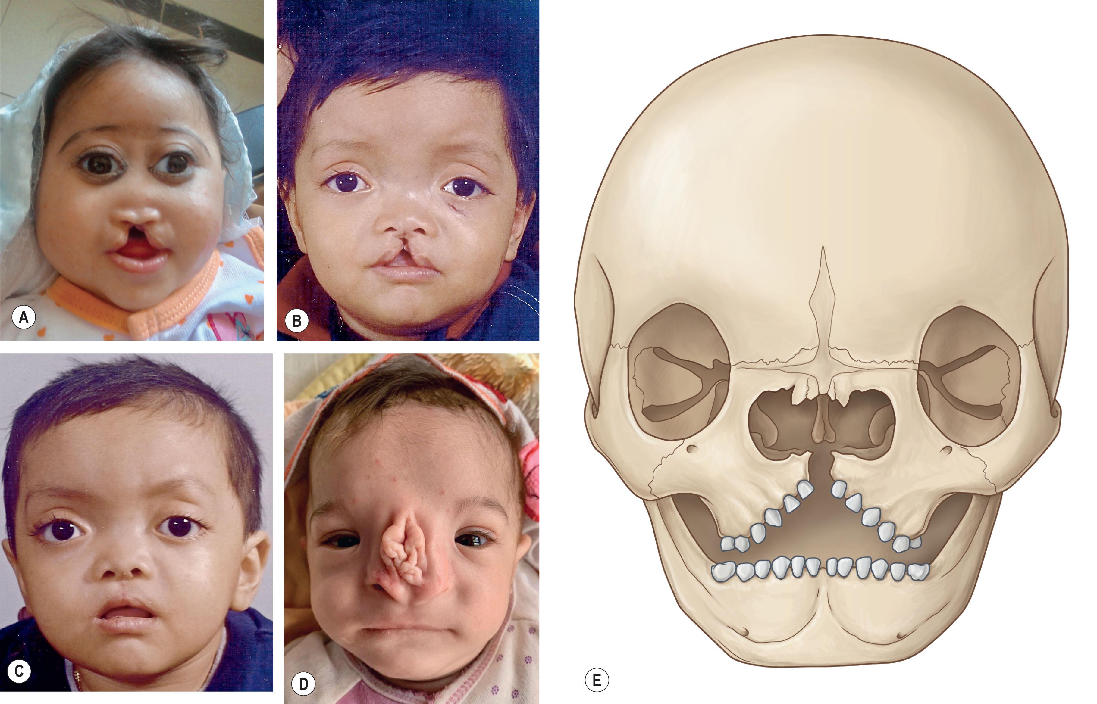 Figure 24.3, Number 0 cleft. (A) Patient with holoproencephalic spectrum (alobar brain) missing premaxilla (tissue deficient = median craniofacial hypoplasia). (B) Patient with a true median cleft lip palate, cleft palate, hypotelorbitism, sphenoethmoidal encephalocele (normal tissue volume but clefted = median craniofacial dysraphia), preoperative view. (C) Postoperative view after median cleft lip repair. (D) Patient with excessive midline tissue manifested by bifid nose and an accessory band of skin on the nasal dorsum (tissue excess = median craniofacial hyperplasia). (E) Illustration of skeletal involvement demonstrates separation between the central incisors, widening of the nasal region, and orbital hypertelorism.