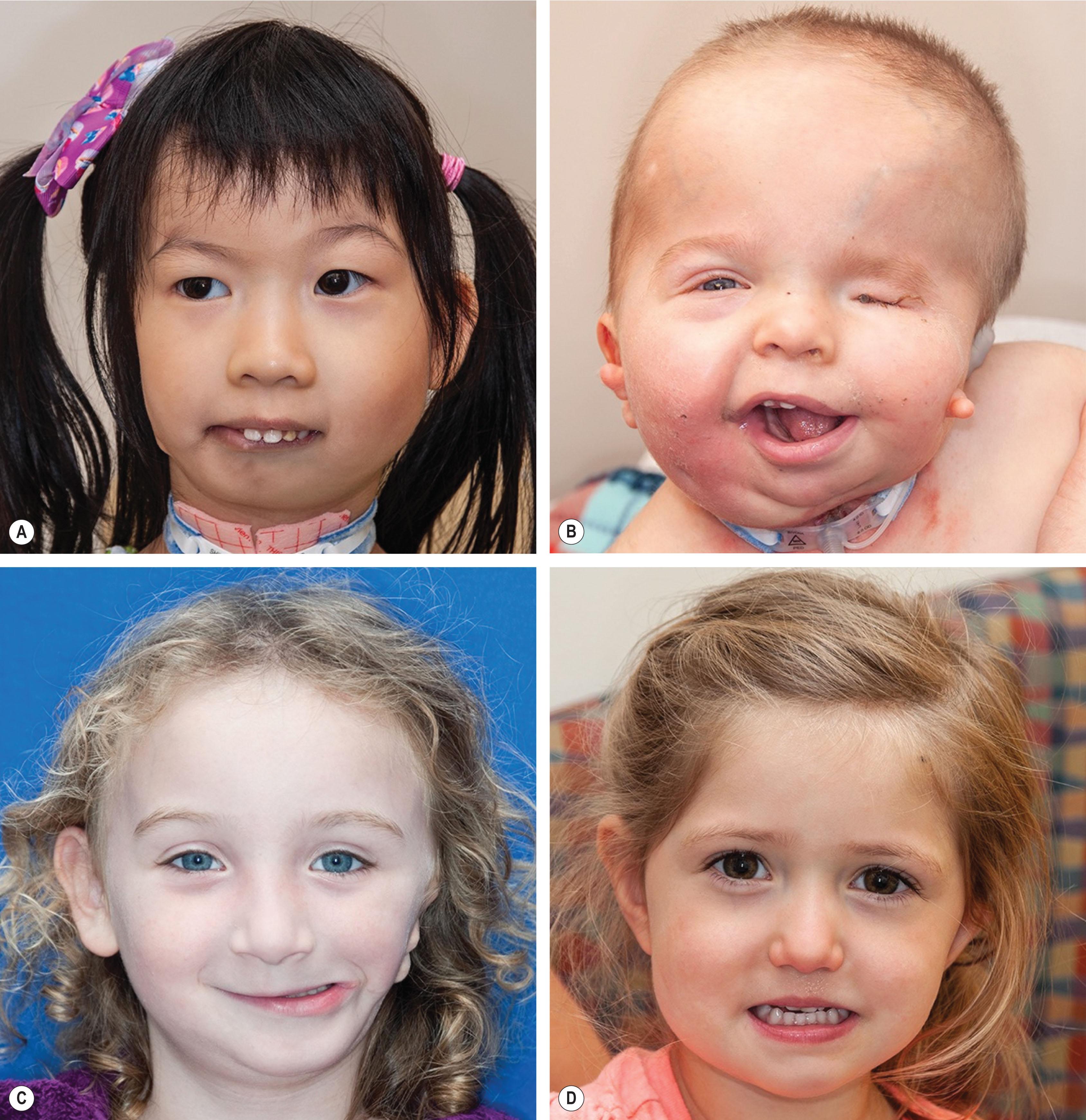 Figure 26.1, (A–D) Phenotypic spectrum of patients with craniofacial microsomia of varying degrees of severity.