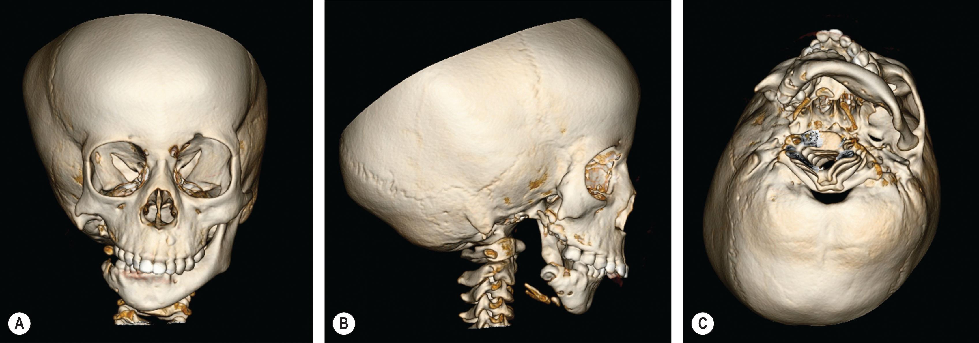 Figure 26.3, 3D maxillofacial CT scan of a patient with CFM displaying a severe right mandibular deformity that includes an absent ramus and condyle as well as a smaller body compared to the contralateral side. Note the absent zygomatic arch and glenoid fossa. (A) Anteroposterior (AP) view. (B) Right lateral view. (C) Worm's eye view.