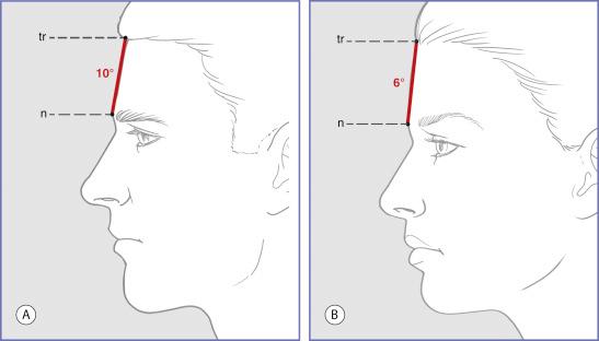 Fig. 5.2, Lateral view of (A) male and (B) female demonstrating normal values in degrees for inclination of the forehead in white North American adult men (ages 19 to 25) ( n = 109) and young white North American women ( n = 200). 1 The inclination of the forehead is more vertical in women than it is men. More often in males frontal sinus development creates a prominence in the central lower forehead that is absent or vestigial in females.