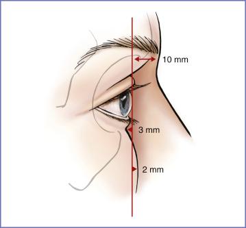 Fig. 5.3, Sagittal relations of the anterior surface of the cornea to the soft tissues overlying the supraorbital and infraorbital rims. On average, in the young adult, the supraorbital rim projects 10 mm beyond, the infraorbital rim lies 3 mm behind, and the cheek prominence projects 2 mm beyond the anterior surface of the cornea. 1 2 3