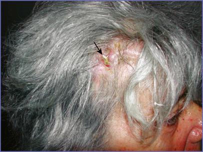 Fig. 5.4, Exposed fixation hardware used to immobilize craniotomy graft after elective craniotomy. The craniotomy incision had been made directly beneath the scalp incision. The resultant exposed fixation hardware (arrow) was positioned directly beneath the scalp closure. Treatment required removal of the hardware and bone graft. A cranioplasty was performed 6 months later.