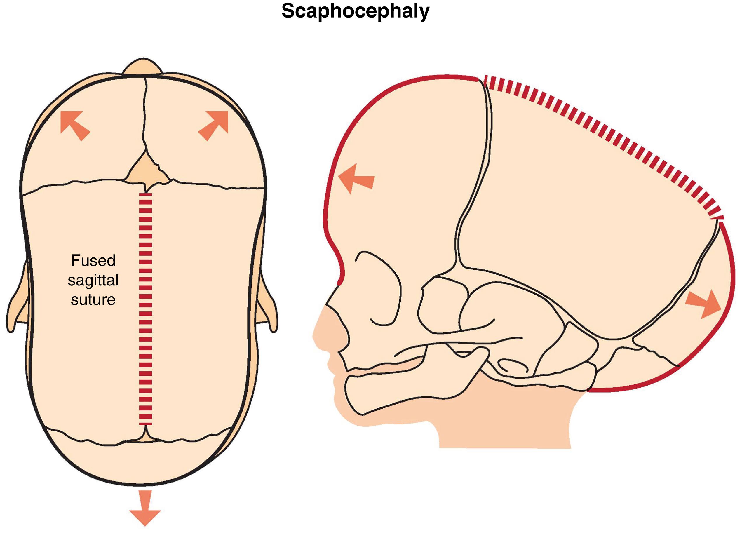 Fig. 20.1, Skull growth in sagittal synostosis causes scaphocephaly.