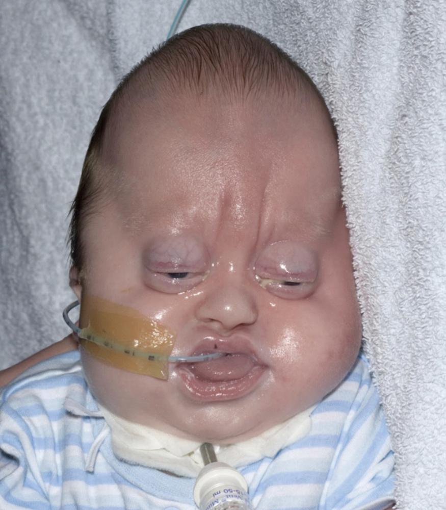 Fig. 20.4, Unoperated Pfeiffer patient, male, age 30 days.