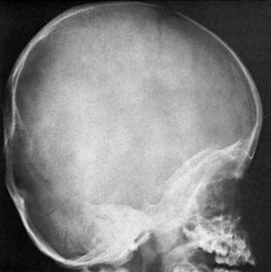 Figure 20.19, Deformational (postural) plagiocephaly in a 22-month-old infant.