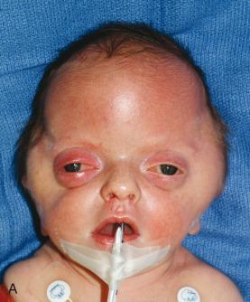 Figure 20.30, Pfeiffer syndrome.