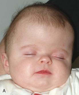 Figure 20.32, Crouzon syndrome in an infant with brachycephaly.