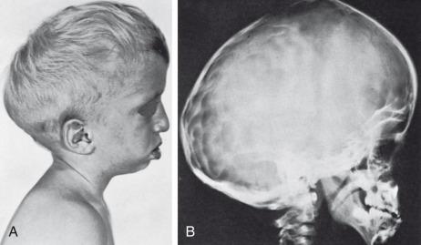 e-Figure 20.31, Crouzon disease (craniofacial dysostosis).