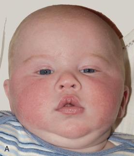 Figure 20.20, Deformational plagiocephaly in an infant.