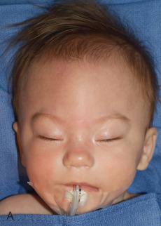 Figure 20.23, Metopic synostosis in an infant with trigonencephaly and hypotelorism.