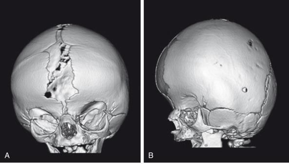 Figure 20.28, Apert syndrome in an 8-day-old infant.