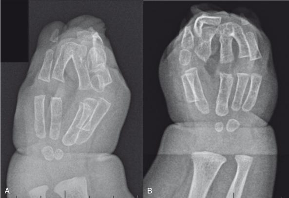 e-Figure 20.26, Bilateral acrocephalosyndactyly, type I (Apert syndrome).