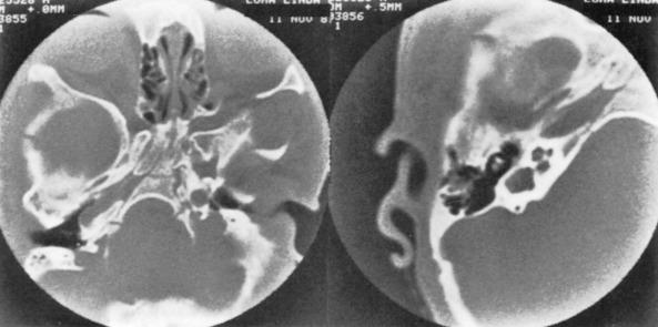 e-Figure 20.27, Bizarre skull base deformity due to asymmetric craniosynostosis in a child with Apert syndrome.