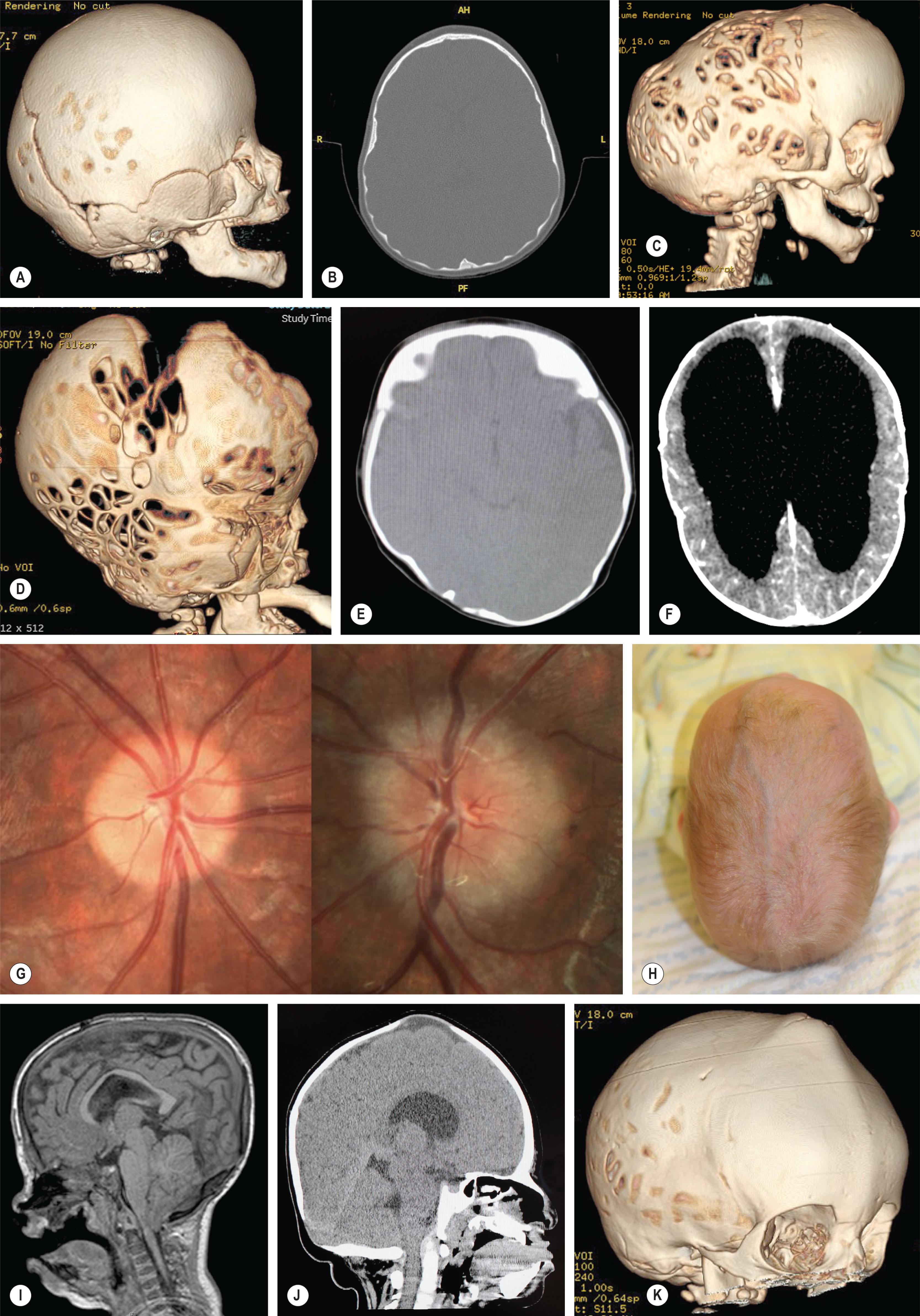 Figure 25.1.12, Indicators of elevated ICP. CT scans show areas of mild bone thinning (A) and endocranial scalloping (B) ; more severe widespread thumbprinting (C) or copper-beaten skull with indentations of the endocranial surface (Lückenschädel skull) (D) ; small compressed tight ventricles with loss of fluid in the subarachnoid space (E) ; severe hydrocephalus (F) ; fundoscopic view showing active papilledema on the right with moderate disc elevation, indistinct margins and mild blurring of the blood vessels. (G) Image on the left is resolved papilledema – the margin is now distinct with no blurring of the blood vessels – the disc remains full and there is mild diffuse pallor; dilated veins on the scalp of an infant with sagittal synostosis due to intracranial shunting of blood through the cutaneous circulation as the result of venous hypertension suggestive of elevated ICP (H) ; Chiari I malformation with descent of the cerebellar tonsils through the foramen magnum (I) ; bulging anterior fontanelle (J) , and 3D CT scan showing bone growth around the bulging anterior fontanelle that can resemble a volcanic crater and is known as the volcano sign (K) .