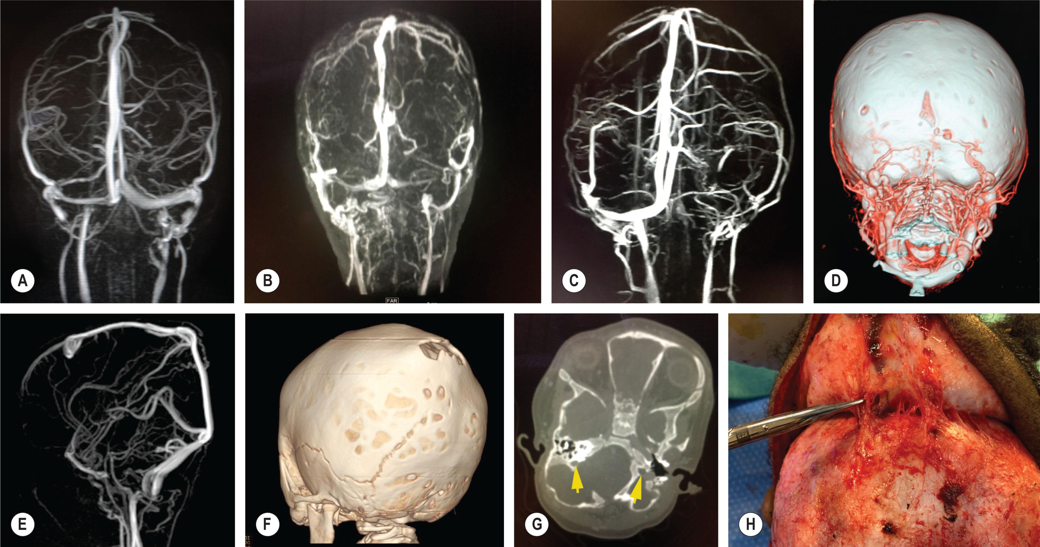 Figure 25.1.13, Venous anomalies are commonly seen in syndromic craniosynostosis. Hypoplasia of the transverse sinus may be unilateral (A) , or bilateral (B) ; absence of right transverse sinus (C) , presence of emissary veins (D) and jugular foramen stenosis (E) . A posterior skull defect (F) is associated with out-pouching of the sagittal sinus with several emissary veins seen on MR venogram (G) and during surgery (H) .