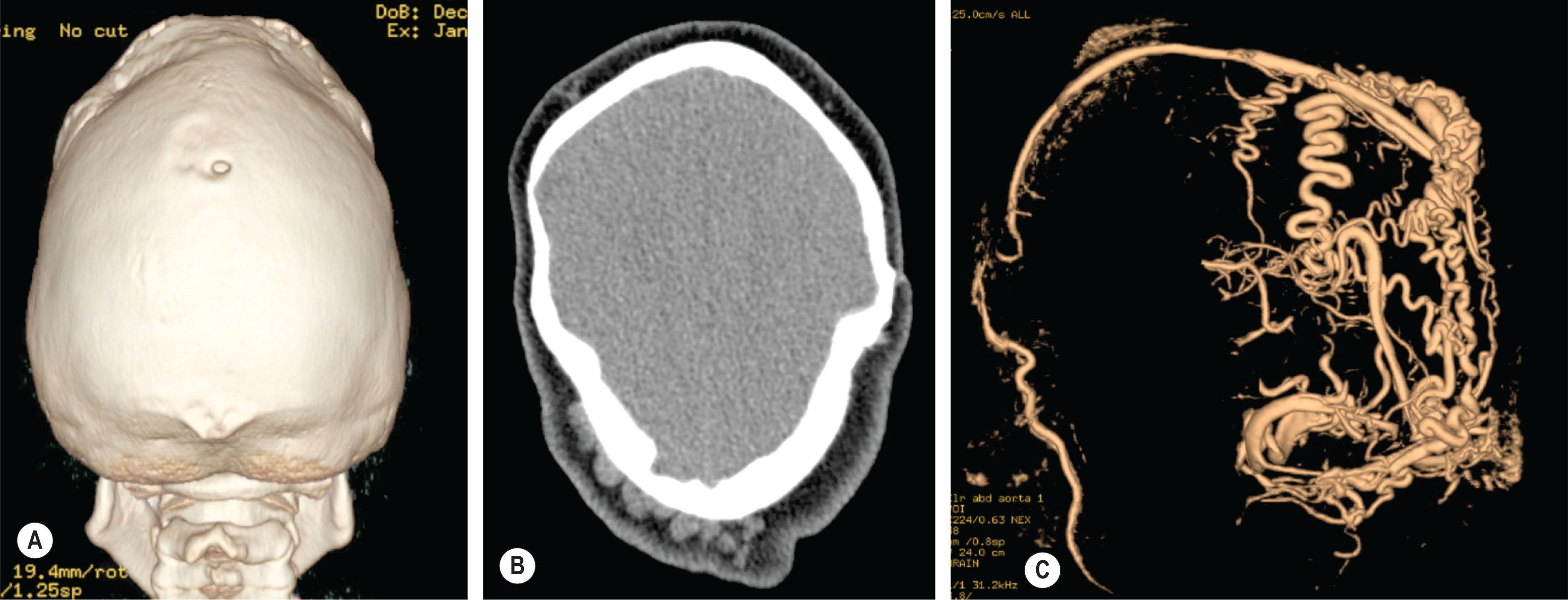 Figure 25.1.14, 3D CT scan showing an innocuous foramen in the midline of a 14-year-old boy with Crouzon syndrome (A) . Axial views demonstrating large dilated subcutaneous veins (B) . MR venogram shows an extensive subcutaneous network of veins emanating from a large emissary vein connected to the sagittal sinus (C) . Disruption of these venous channels during surgery could be associated with acute intracranial hypertension and mortality.