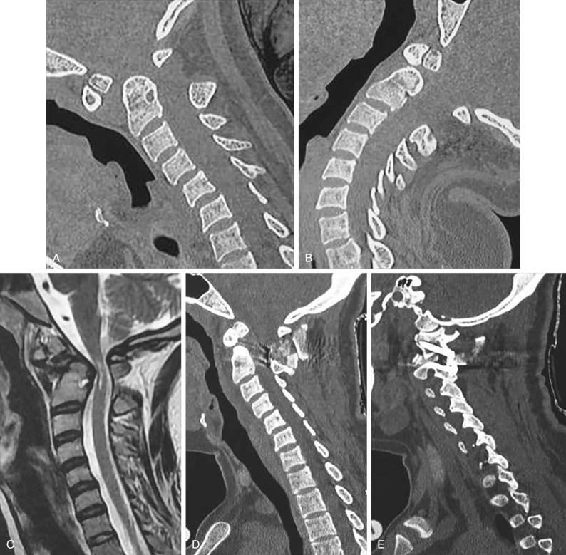 Figure 34.2, A 35-year-old female patient with a mobile atlantoaxial dislocation. (A) Sagittal image of CT scan with the head in flexed position shows os-odontoideum and atlantoaxial instability. (B) CT scan with the head in extension shows reduction of the dislocation. (C) T2-weighted image with the head in flexion shows evidence of cord changes. (D) Postoperative CT scan shows fixation of the atlantoaxial joint in reduced position. (E) Postoperative CT scan with sagittal cuts through the facets showing the metal implant.