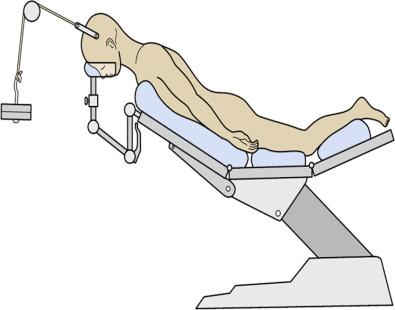 Figure 34.3, Line drawing showing the patient position. The patient is placed under cervical traction, and the head end of the table is elevated. The head is “floating.”