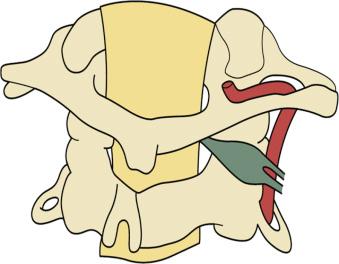 Figure 34.4, Line drawing showing the relation of second cervical ganglion to the vertebral artery and atlantoaxial facet joint.
