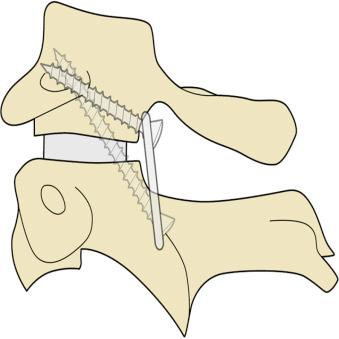 Figure 34.6, Line drawing showing the construct. Metal plate is placed flush to the lateral masses of atlas and axis after adequately preparing the host area. A screw is passed directly into the facet of C1 through a hole in the plate. The C2 screw is a transarticular screw as described by Magerl. Bone graft with or without a spacer is placed in the articular cavity.