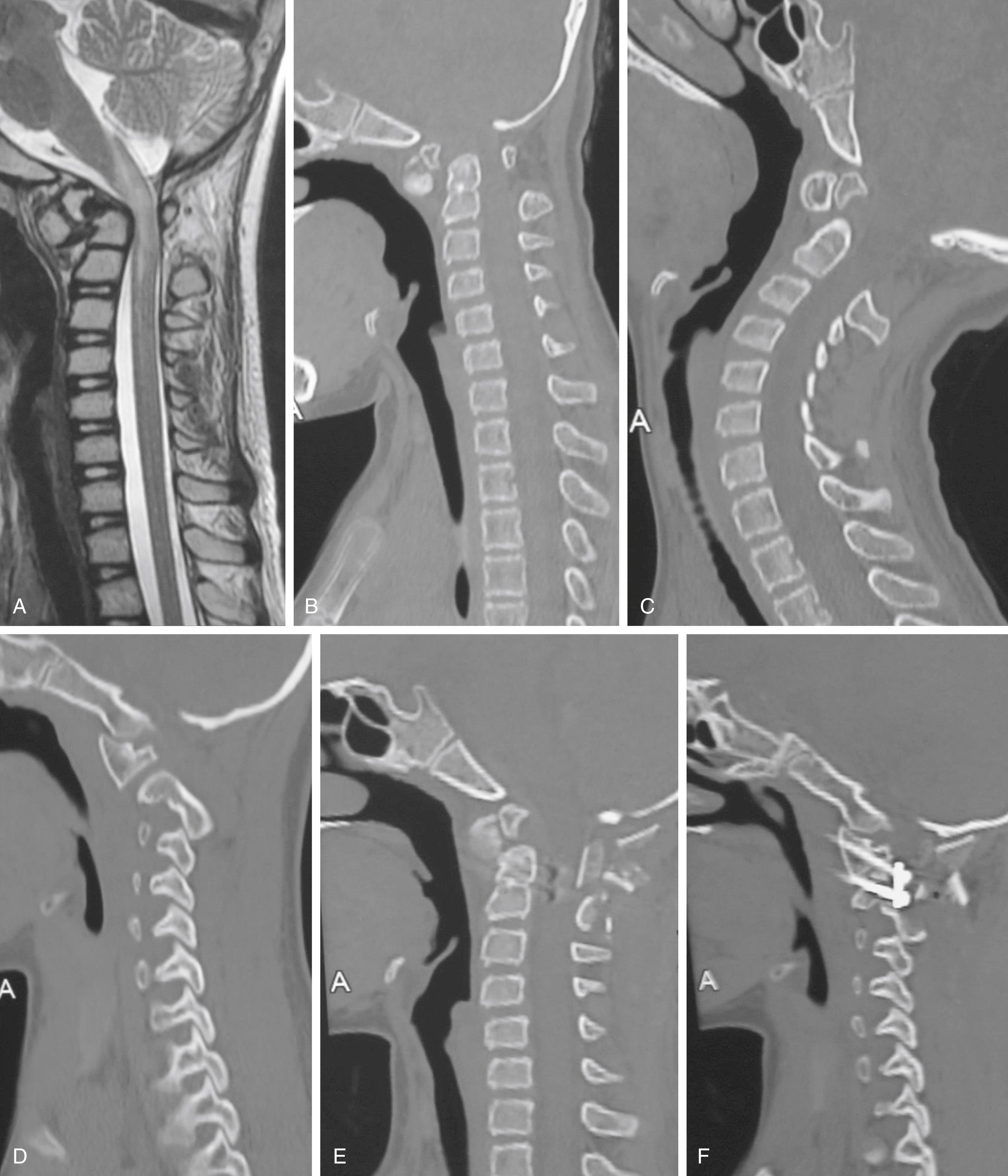 Fig. 24.1, Magnetic resonance imaging (MRI) and computed tomography (CT) images of a 10-year-old female child with atlantoaxial dislocation. A, T2-weighted MRI showing atlantoaxial dislocation and cord compression. B, CT scan with the head in flexion shows atlantoaxial dislocation. Os odontoideum can be seen. C, CT scan with the head in extension showing reduction of the dislocation. D, CT scan with the cut passing through the facets showing the type 1 facetal instability. E, Postoperative CT scan showing atlantoaxial fixation in a reduced position. F, Image showing the implants in the facets of atlas and axis.