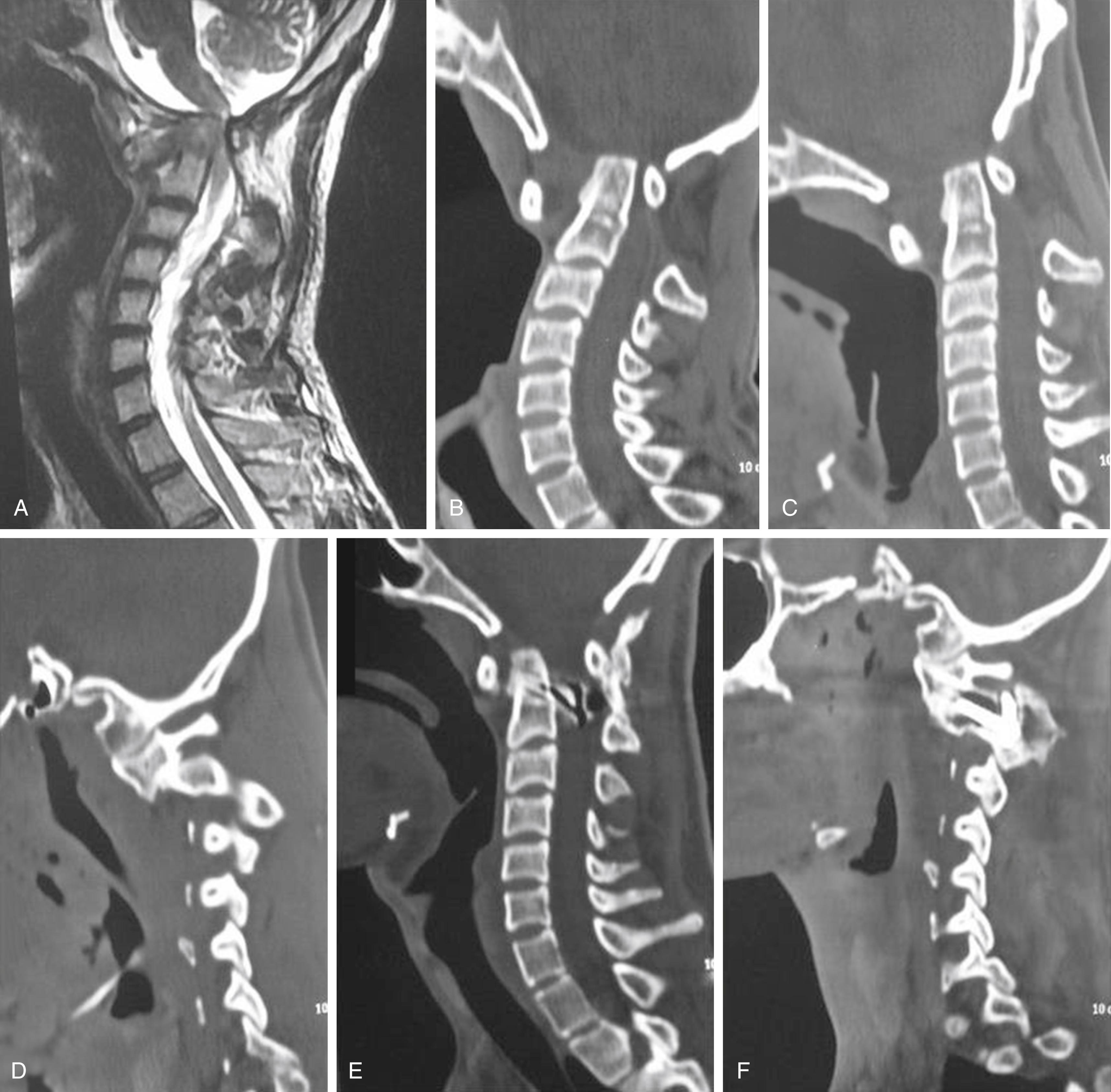 Fig. 24.2, Magnetic resonance imaging (MRI) and computed tomography (CT) images of a 22-year-old male patient with atlantoaxial dislocation. A, T2-weighted MRI showing “irreducible” atlantoaxial dislocation and cord compression. B, CT scan with the head in a flexed position showing severe atlantoaxial dislocation. C, CT scan with the head in an extension position does not show any reduction in atlantoaxial dislocation. D, CT scan cut through the facets showing type I atlantoaxial dislocation. E, Delayed postoperative CT scan showing realignment of the craniovertebral junction and the atlantoaxial fusion. F, Postoperative image through the facets showing lateral mass plate and screw fixation.