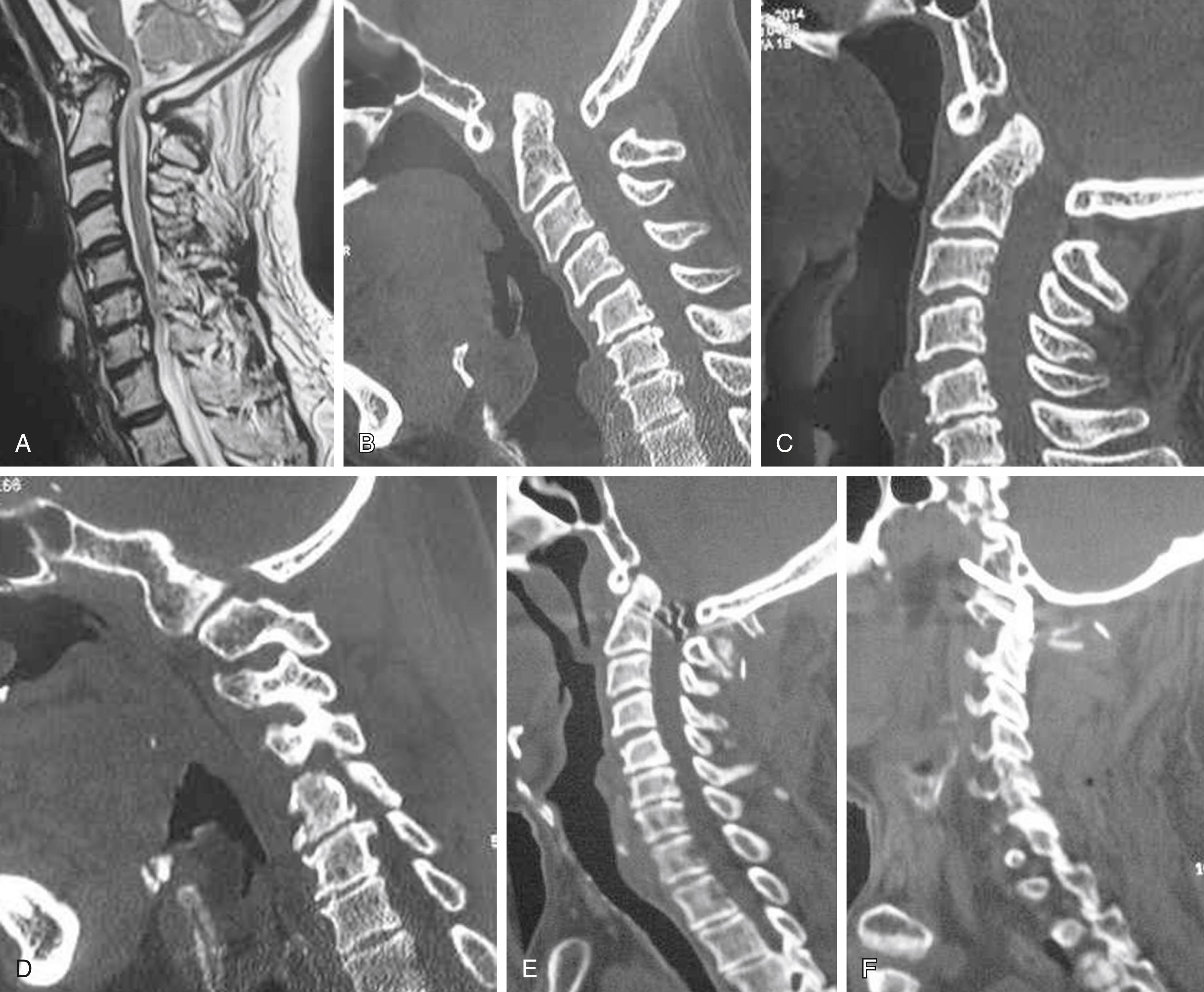 Fig. 24.3, Magnetic resonance imaging (MRI) and computed tomography (CT) images of a 28-year-old male patient with basilar invagination. A, T2-weighted MRI image showing basilar invagination, assimilation of the atlas, and cord compression. B, CT scan with the head in a flexed position showing basilar invagination in the form of vertical or superior migration of the odontoid. C, CT scan with the head in extension showing reduction of the dislocation. D, CT scan cut through the facets showing no significant malalignment. E, Postoperative CT scan showing realignment of the craniovertebral junction. F, Postoperative image through the facets showing lateral mass plate and screw fixation.