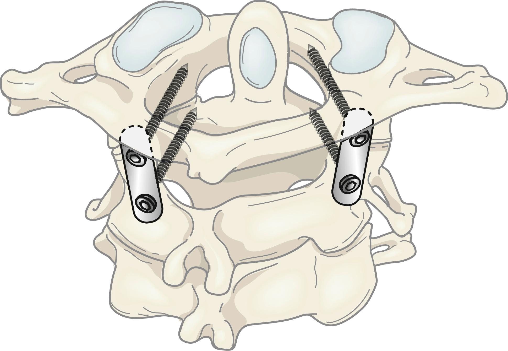 Fig. 24.4, Line drawing showing lateral mass plate and screw fixation. The rostral screw is placed in the facet of C1, and the inferior screw is placed in the facet of C2 through the pars/pedicle.