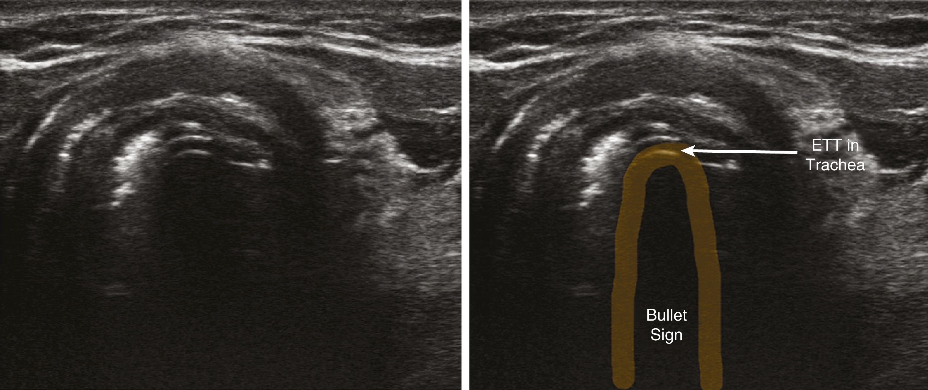 Figure 32.13, Endotracheal tube in the trachea: bullet sign. ETT , Endotracheal tube.