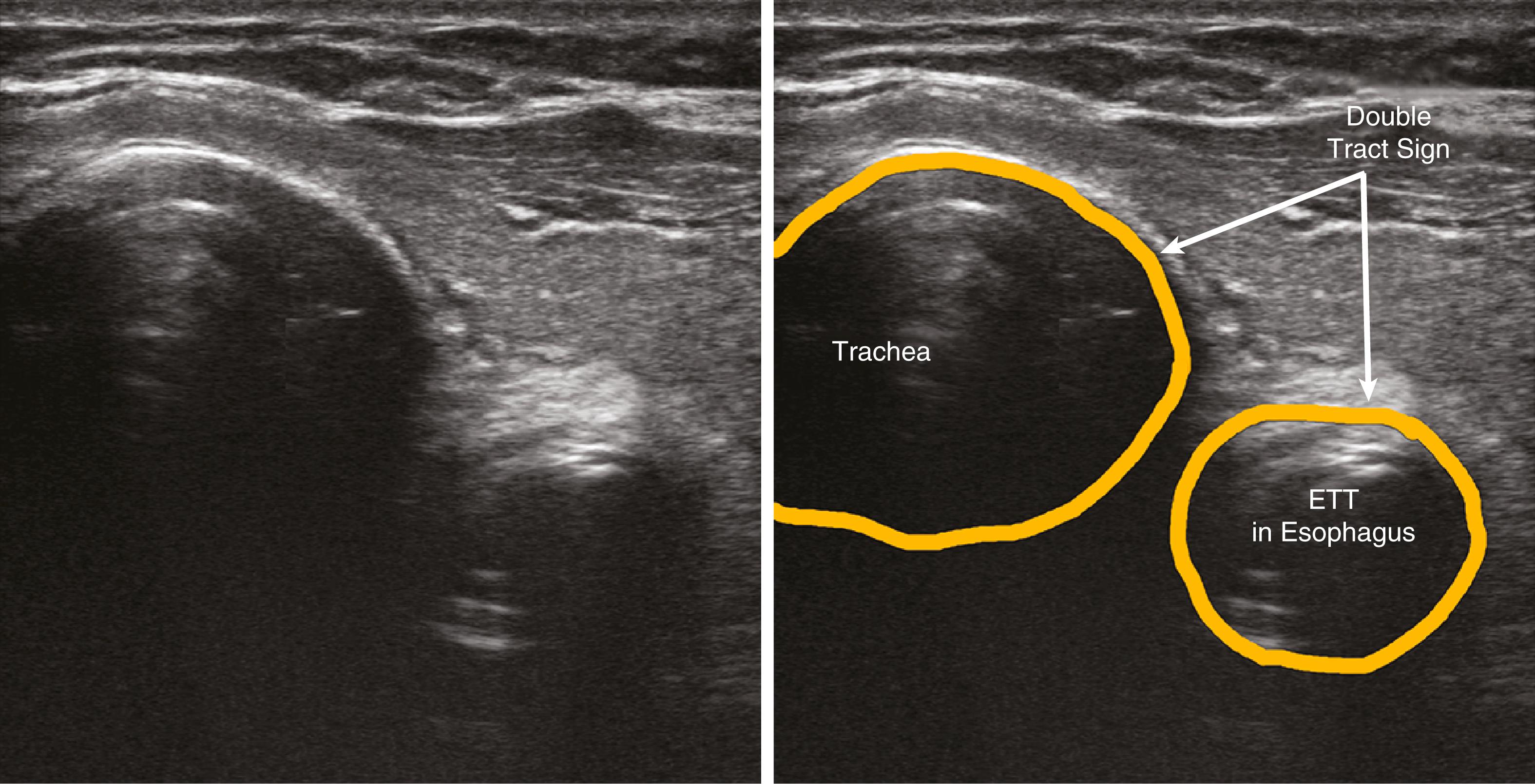 Figure 32.14, Transverse scan of the neck showing endotracheal tube in the esophagus. The double tract sign. ETT , Endotracheal tube.