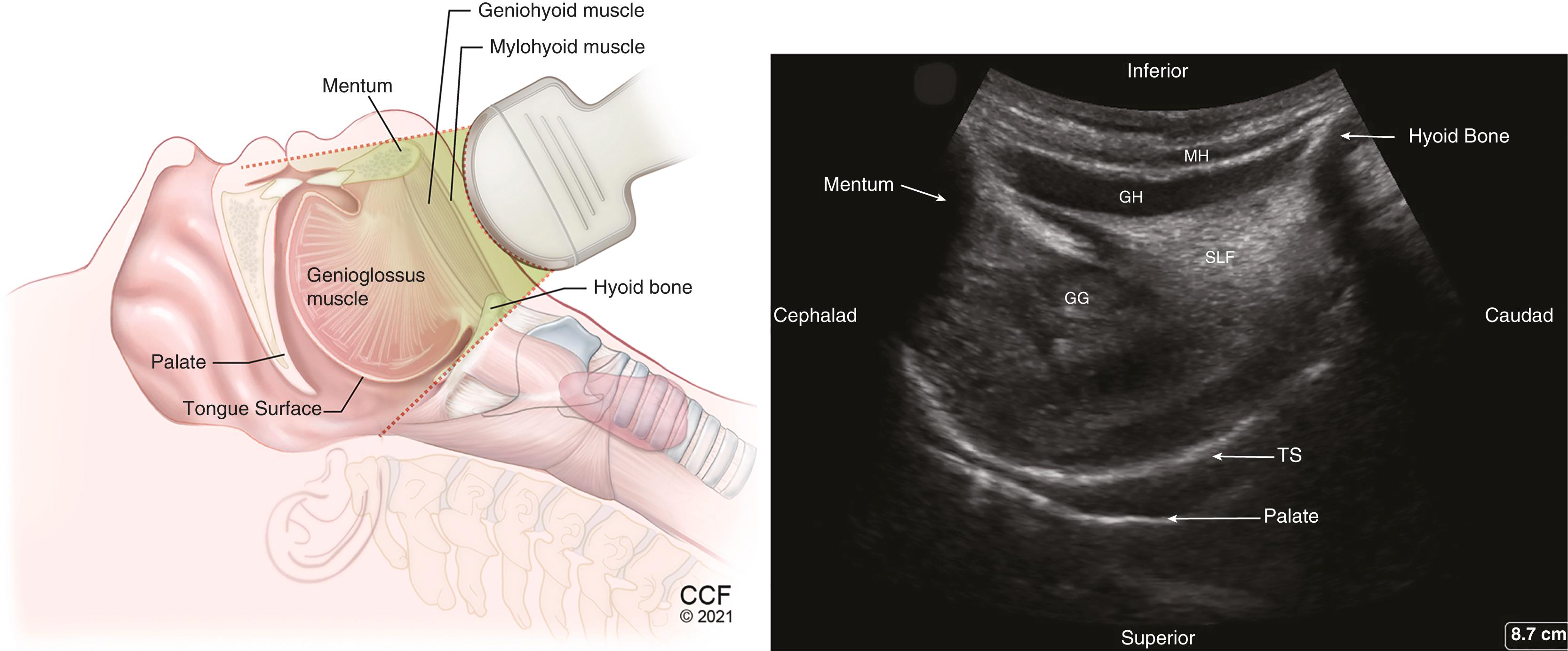 Figure 32.2, Sagittal view of the suprahyoid structures using a low-frequency transducer placed in the submandibular area behind the mentum. GG , Genioglossus muscle; GH , geniohyoid muscle; MH , mylohyoid muscle; SLF , sublingual fat; TS , dorsal tongue surface.