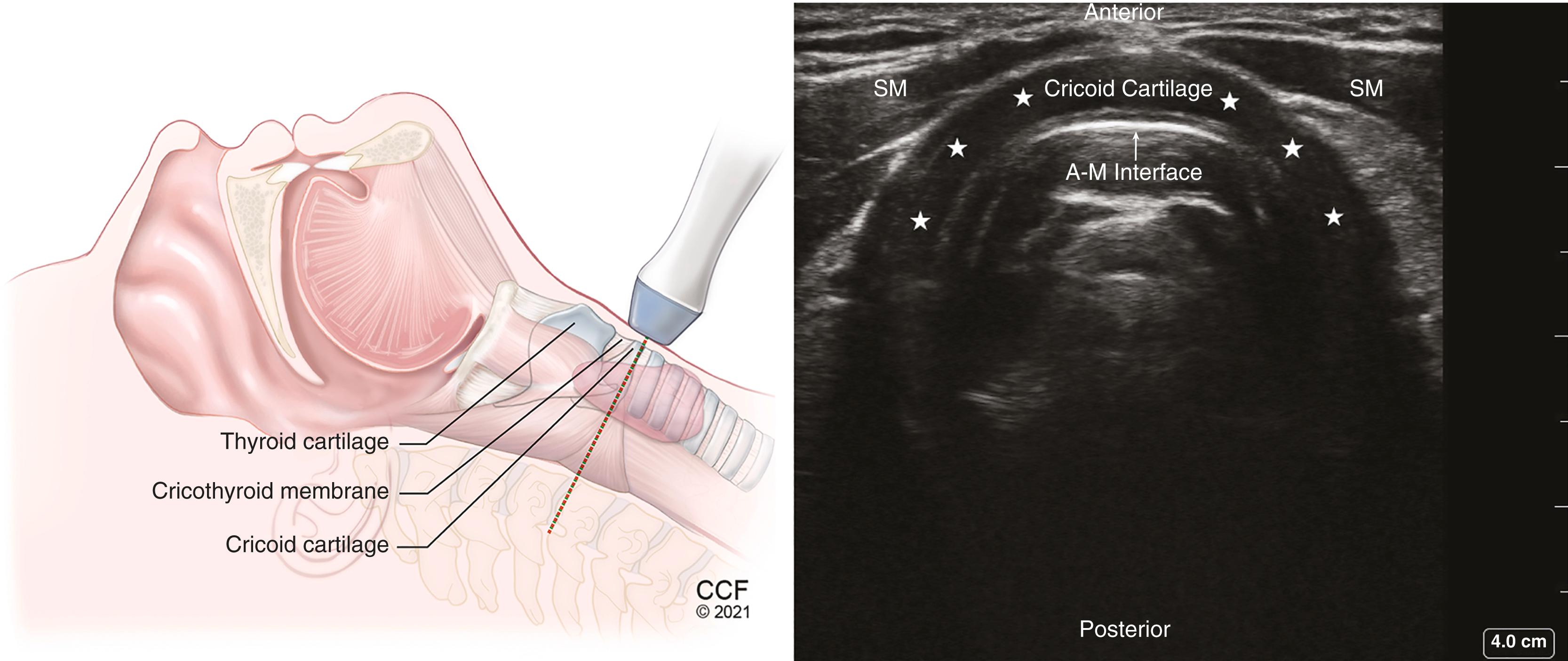 Figure 32.8, Transverse view of cricoid cartilage with a high-frequency, linear transducer over the cricoid cartilage. Hypoechoic arch-shaped cricoid cartilage marked with stars . A-M , Air-mucosal interface; SM , strap muscle.