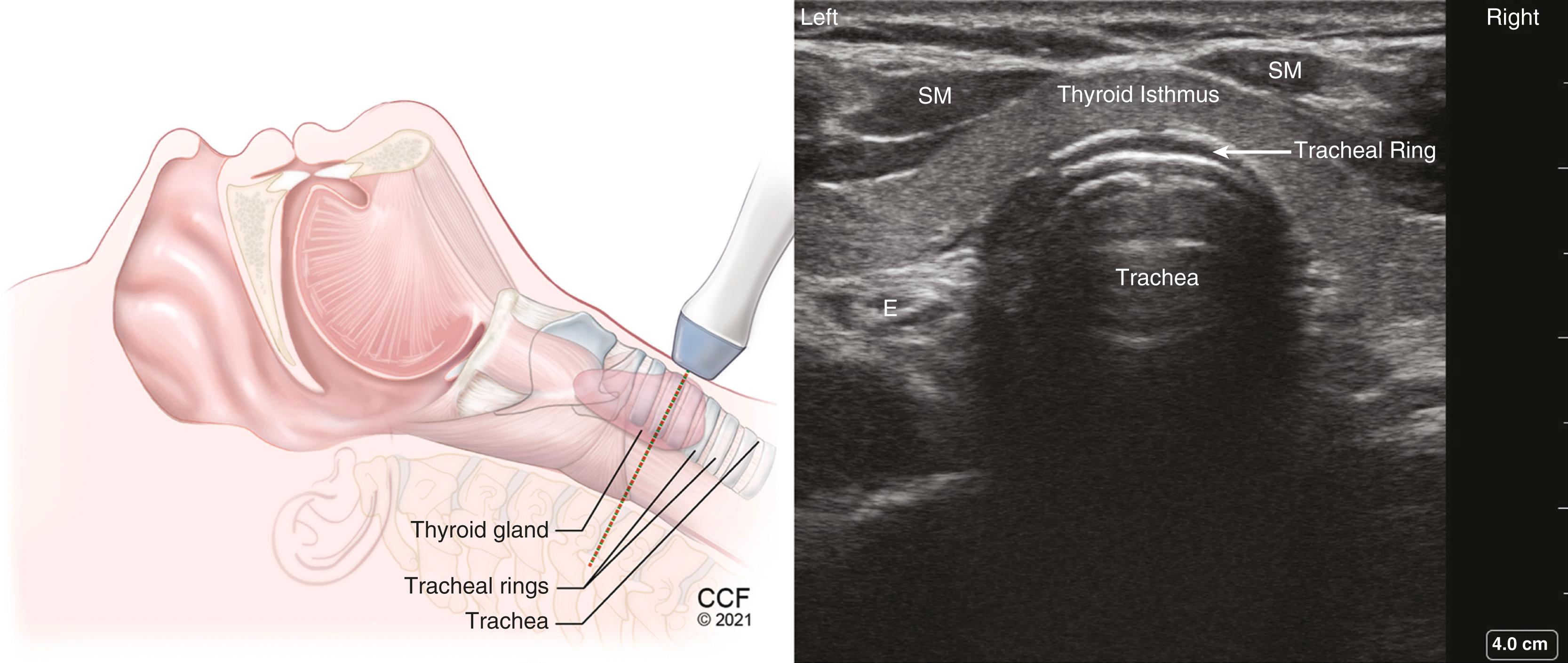 Figure 32.9, Transverse view of tracheal ring above suprasternal notch with a high-frequency, linear transducer. Hypoechoic tracheal ring lined inside by hyperechoic A-M interface. A-M , Air-mucosal interface; E , esophagus to the left of trachea; SM , strap muscle.